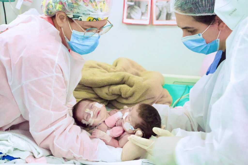 gemeas-siamesas-de-manaus-passam-por-cirurgia-de-separacao