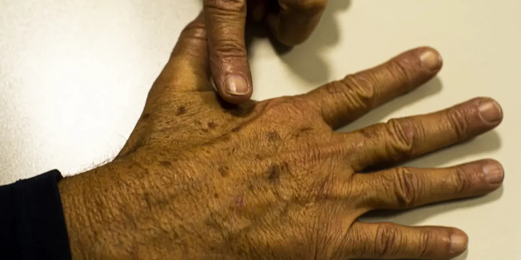 cancer-de-pele-e-identificado-em-bolsonaro,-mas-medicos-descartam-novos-tratamentos